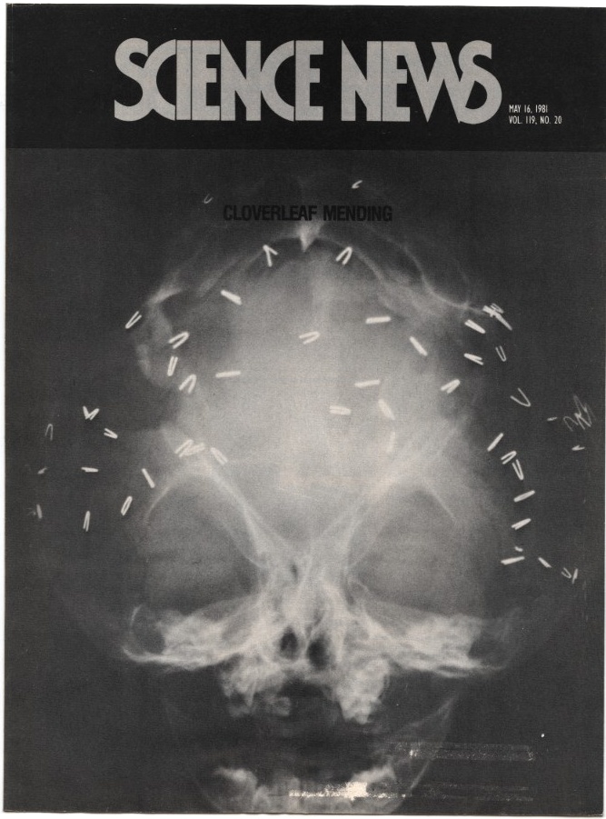 Science News May 16 1981 Repairing skull and facial deformities